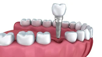 Restorative Dentistry